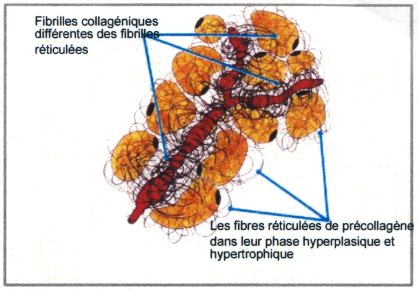 Formation de «poches» de fibres de collagène emprisonnant le gras
